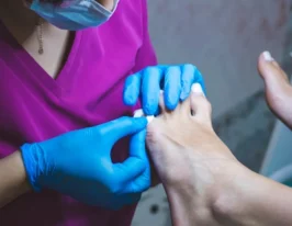 Odciski latem – dlaczego powstają i jak im zapobiegać?